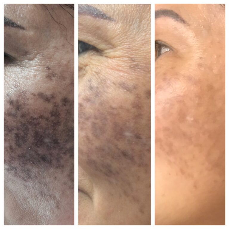 dark-spot_hyperpigmentation-removal.jpg